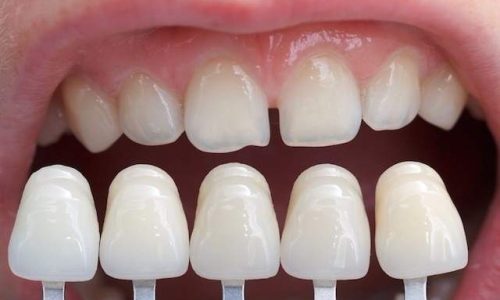 Adolescentes podem colocar lentes nos dentes? Descubra aqui!