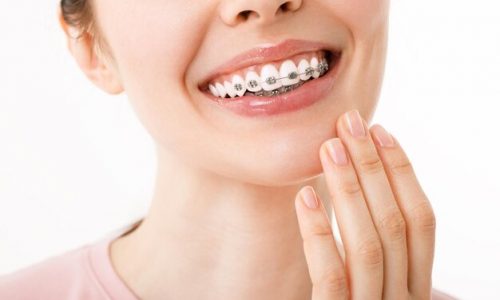 Transforme seu sorriso: Descubra por que colocar aparelhos dentários em Eunápolis!