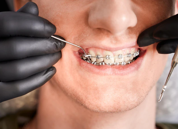 Quais são os benefícios de usar aparelhos dentários?