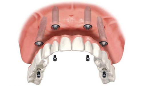 Melhor clínica de implantes dentários em Belo Horizonte: resultados eficazes e atendimento humanizado