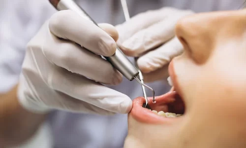 Implantodontia: como recuperar os dentes perdidos