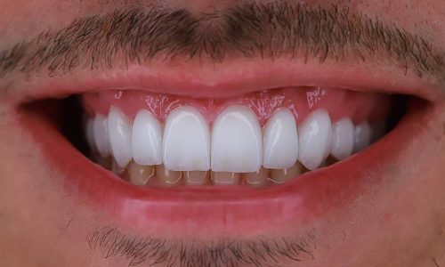 Lentes de Contato Dentais: Um Sorriso Transformador