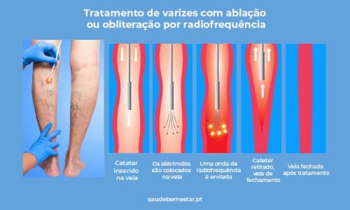 Desvendando os Raios de Esperança: Tratamento de Varizes a Laser e seus Benefícios Brilhantes