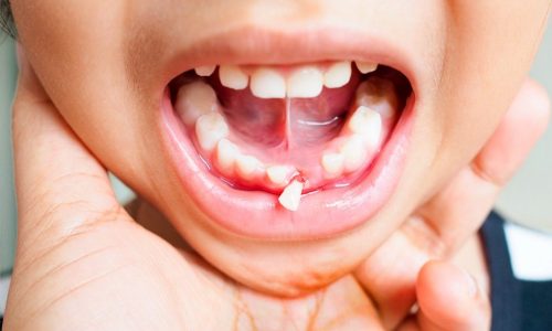 Trauma dental: causas, sintomas e tratamento