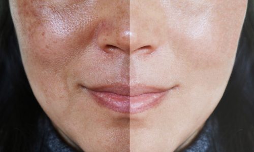 Tratamento a Laser para Melasma: Resultados Rápidos e Eficazes