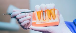 Procedimento de implantes dentários