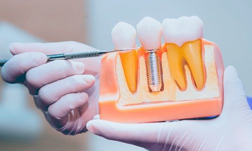 Procedimento de implantes dentários: o que você precisa saber