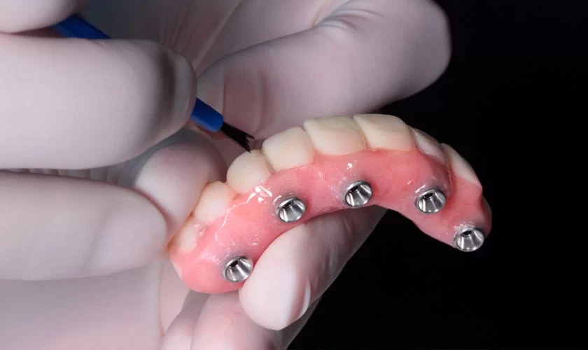 Procedimento de implantes dentários