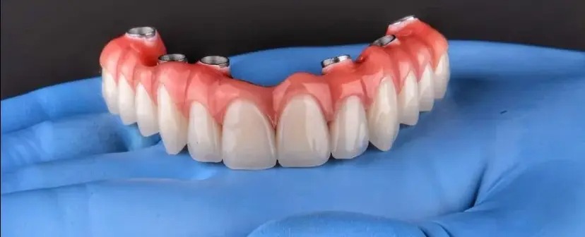 Procedimento de implantes dentários